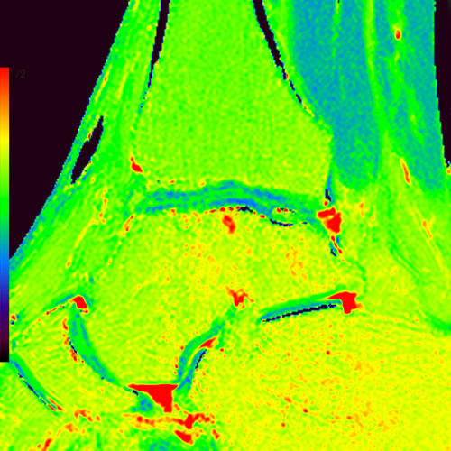MRI // T2 mapping
