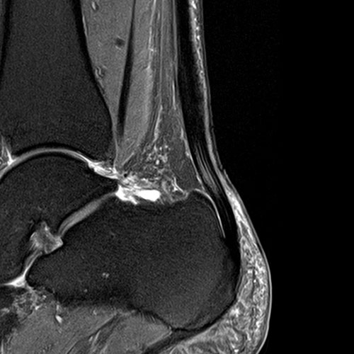 MRI