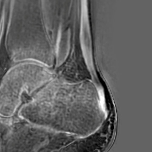 MRI