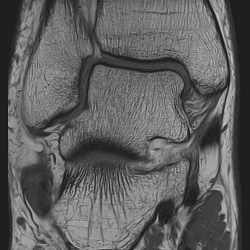 MRI