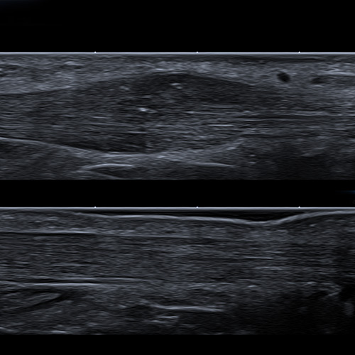 Ultrasound // Achilles Tendinopathy, R & L Comparison