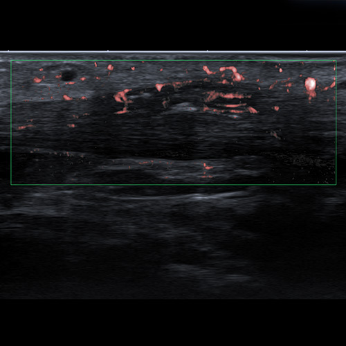 Ultrasound // Achllies Tendon with SMI