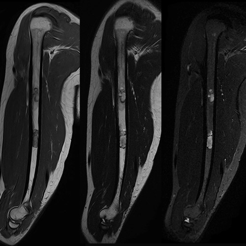 MRI
