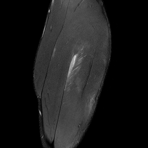 MRI