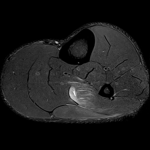 MRI