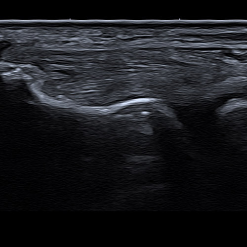 Ultrasound // Lateral Epicondyle