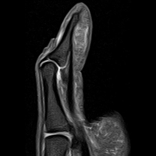 MRI