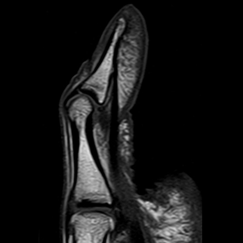 MRI
