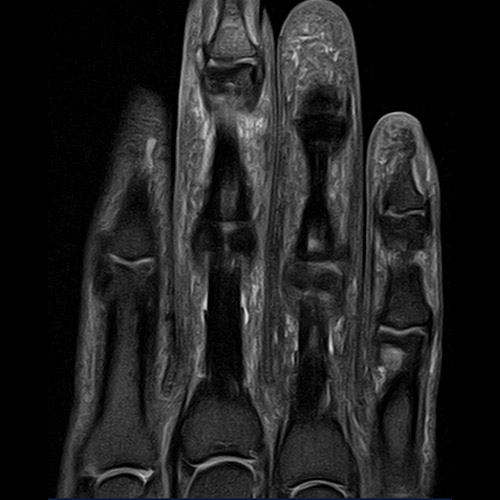 MRI