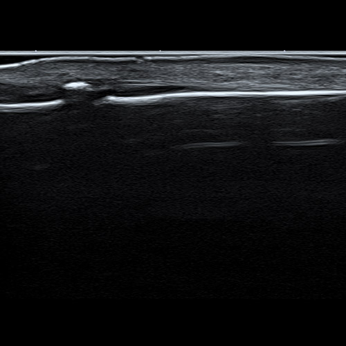 Ultrasound // Right ring finger