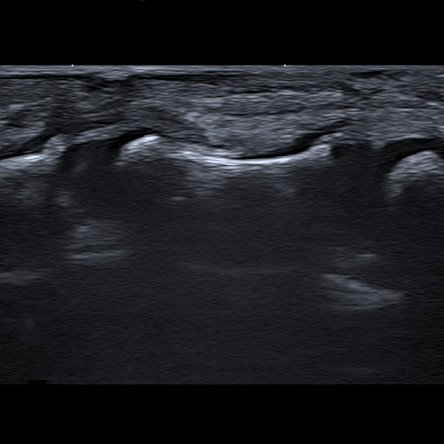 Ultrasound // Pediatric Digital nerve