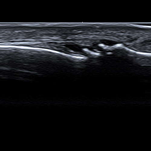 Ultrasound // Heberden's nodes