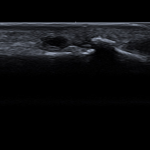 Ultrasound // Heberden's nodes