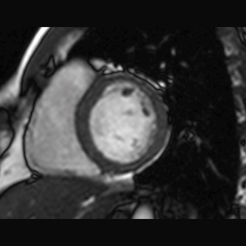 MRI
