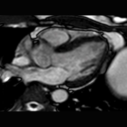 MRI
