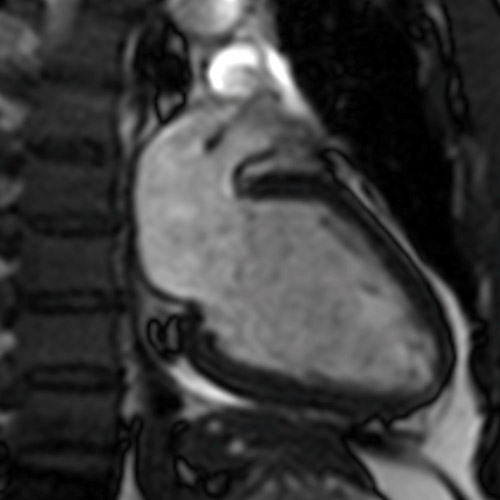 MRI