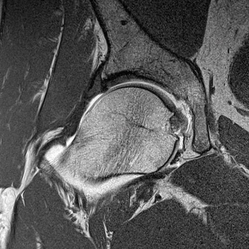 MRI // Hip Arthrography