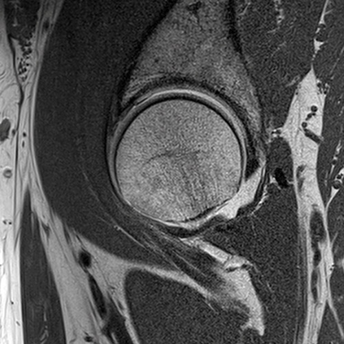 MRI // Hip Arthrography