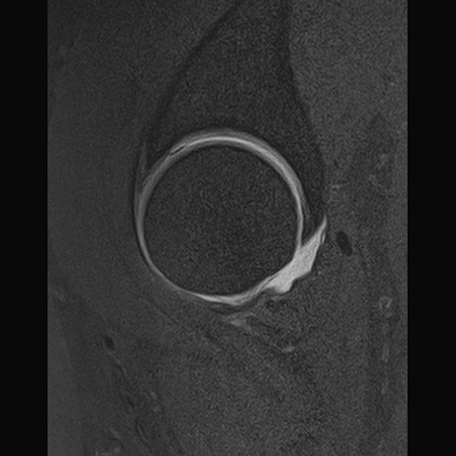 MRI // Hip Arthrography