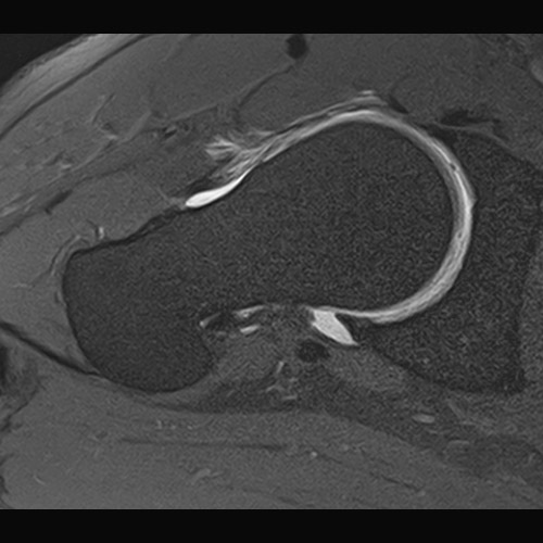 MRI // Hip Arthrography
