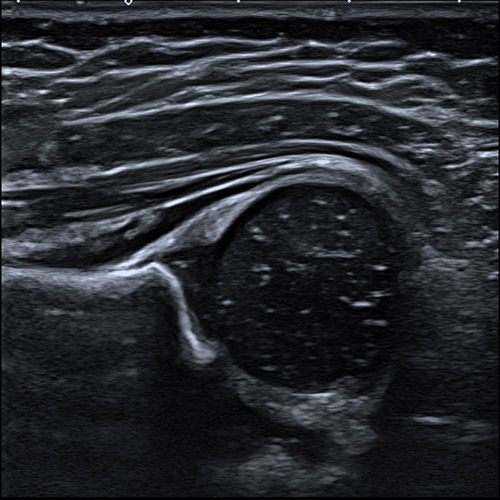 Ultrasound
