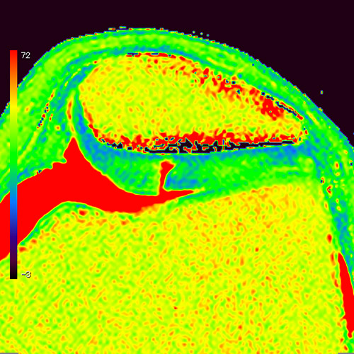 MRI