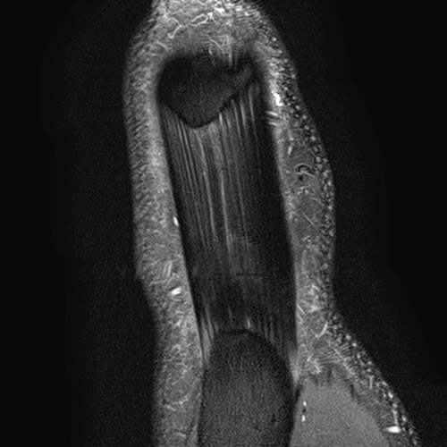 MRI // Patellar tendon