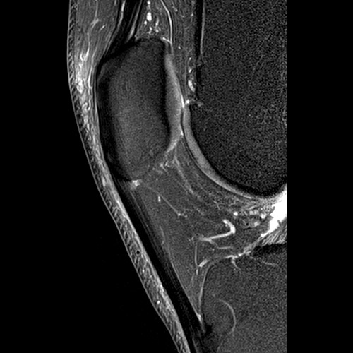 MRI // Patellar tendon