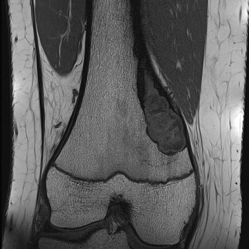 MRI // Bone Tumor