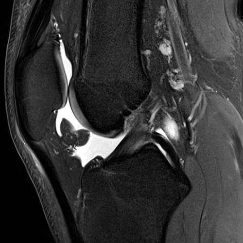 MRI