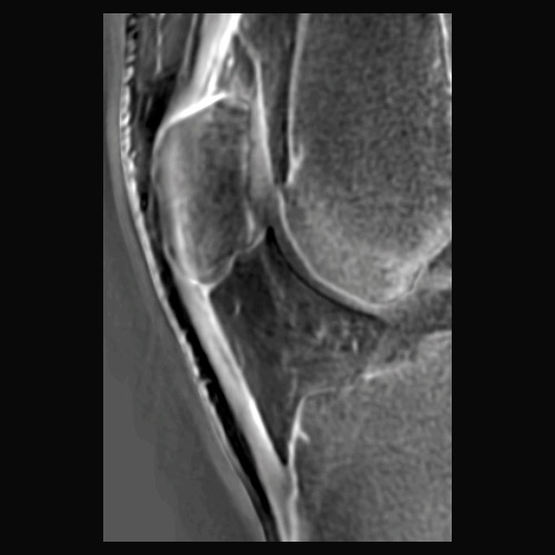 MRI // Patellar tendon