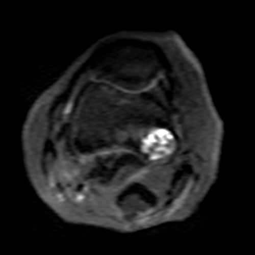 MRI // Bone Tumor