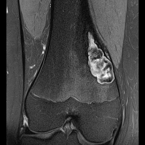 MRI // Bone Tumor