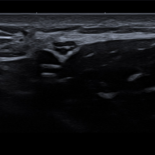 Brachial Nerve