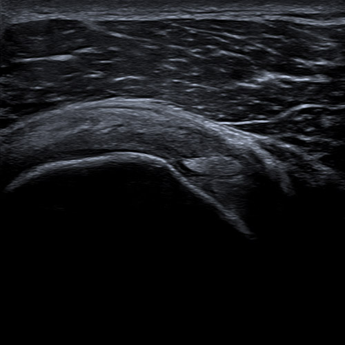 Supra Spinatus tendon