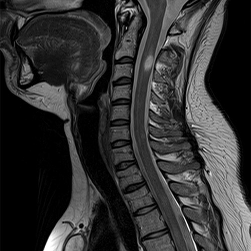 MRI // C-Spine