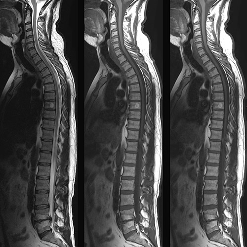 MRI // Whole Spine