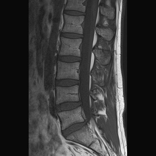 MRI // L-Spine