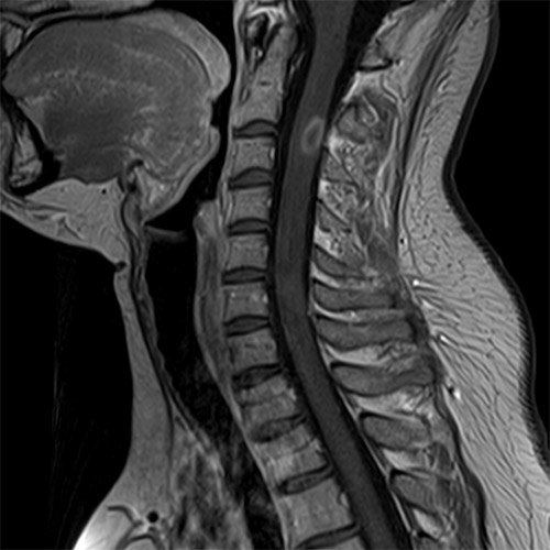 MRI // C-Spine