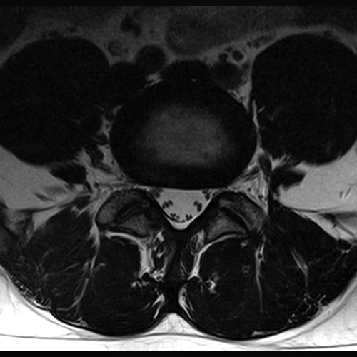 MRI // L-Spine