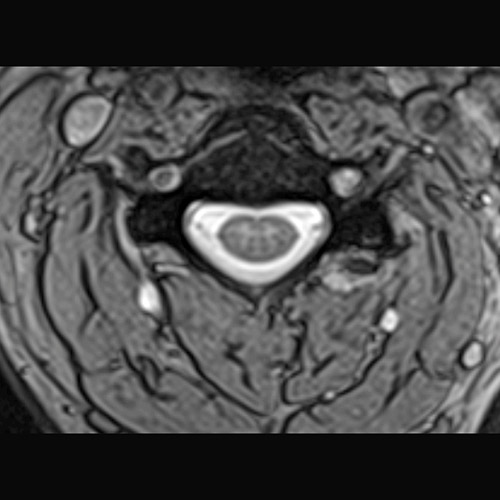 MRI // C-Spine
