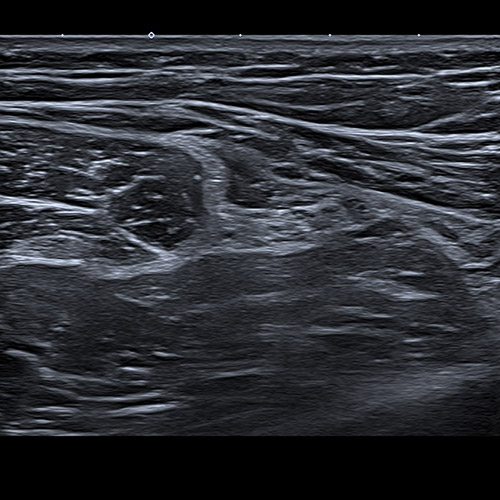 Ultrasound // Hamstring