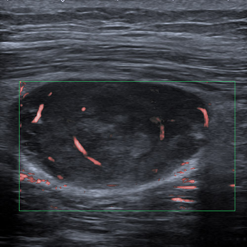 Ultrasound // Spindle cell lesion