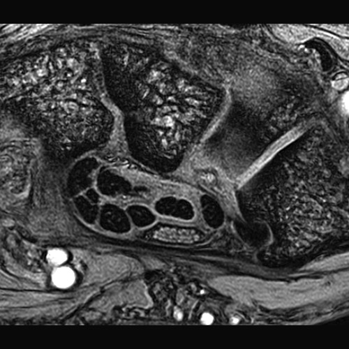 MRI