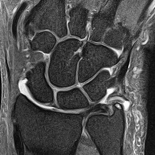 MRI