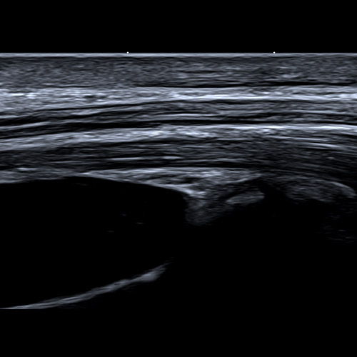 Ultrasound // Long view