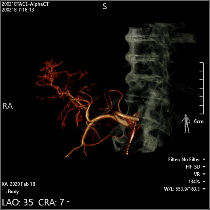 Alphenix Abdominal Alpha CT