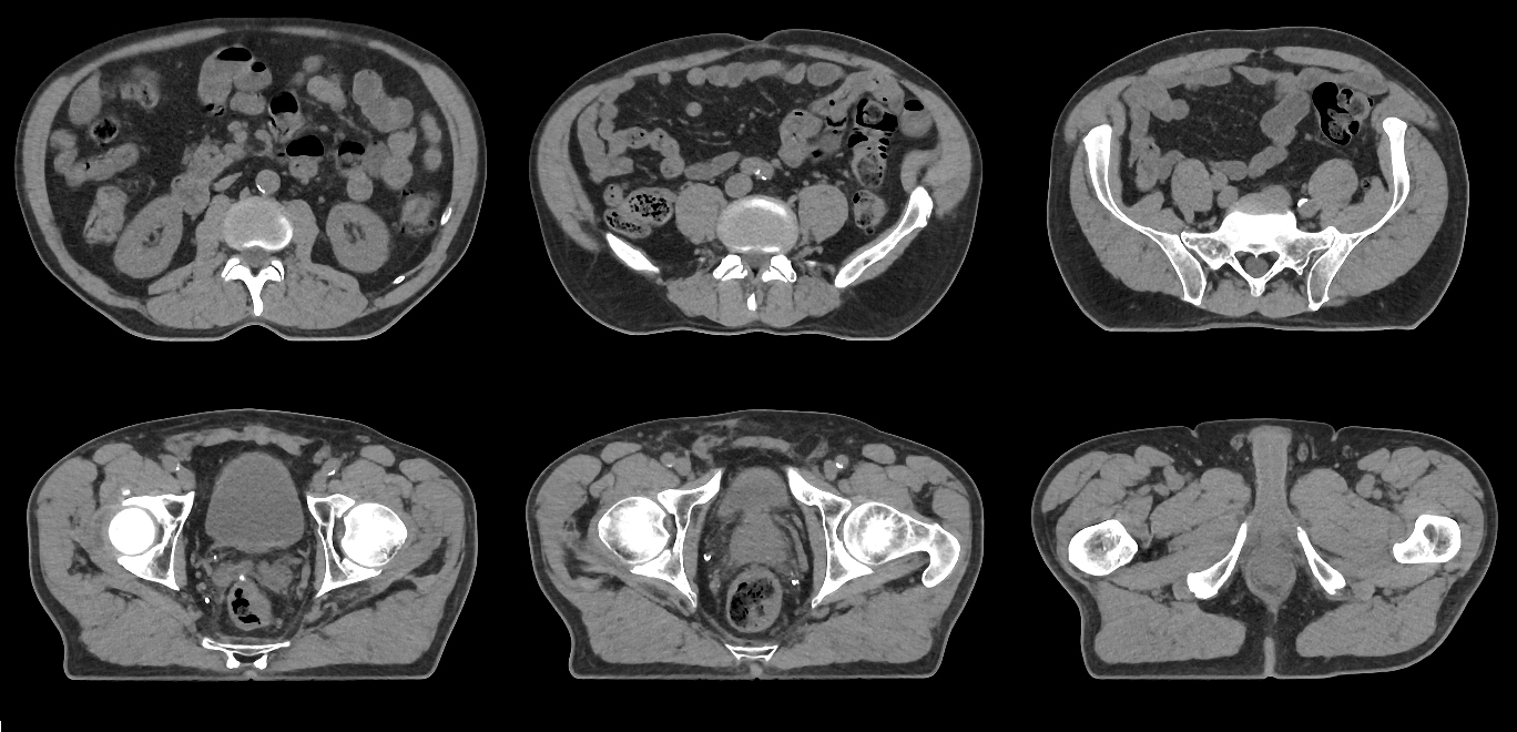 Abdômen e Pelve