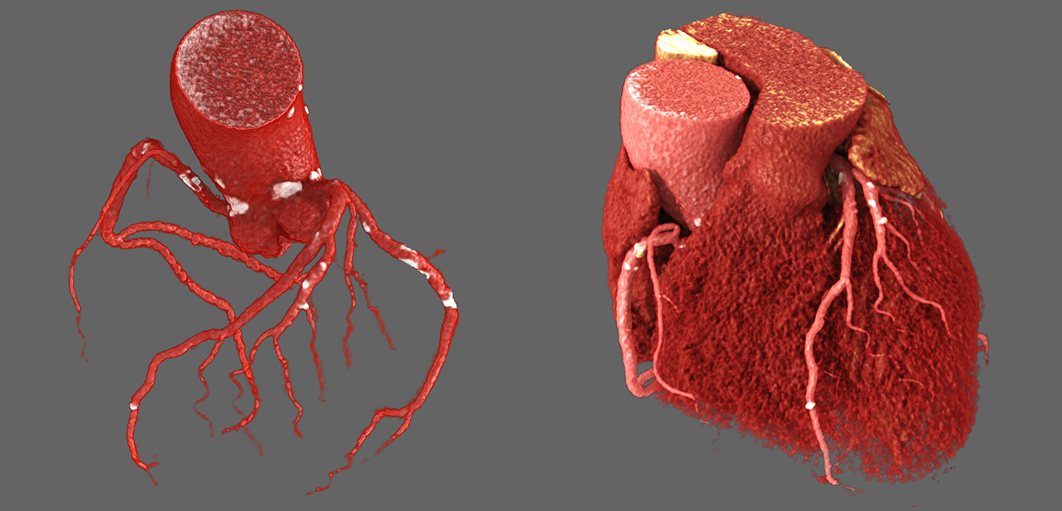 Cardiac - 3 vessel disease