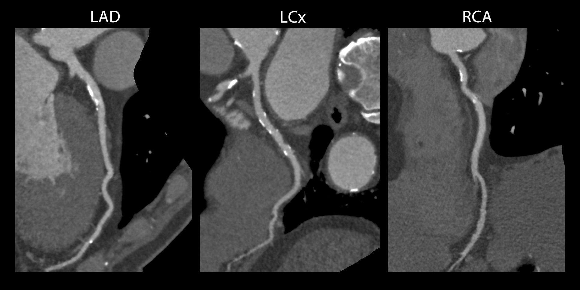 Cardiac - 3 vessel disease